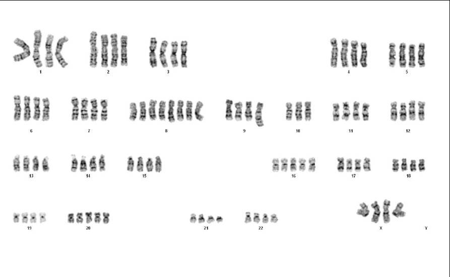 Cytogenetics on a portion of disaggregated bone marrow biopsy showing abnormal hypertetraploid karyotype with t(1;9)(q21;q22)